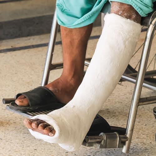 Hombre en silla de ruedas con yeso en la pierna rota - Abogados de lesiones articulares en Texas