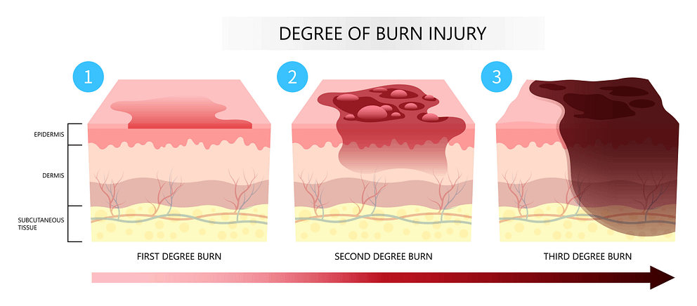 Skin burn injury degree of epidermis tissue layer with flames exposure. Texas burn injury lawyers.